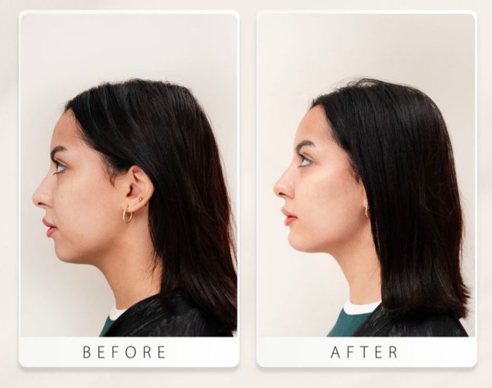 إجراء شد مائي بالفيلر لدى الدكتور عبدالله الراشد