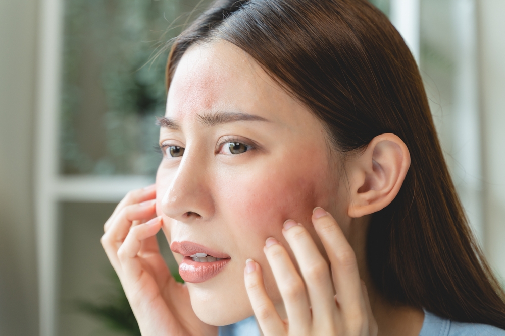 الإكزيما (Eczema)  من الأمراض الجلدية التي تصيب طبقات الجلد وتترافق مع احمرار، حكة، قشور بيضاء وتشققات