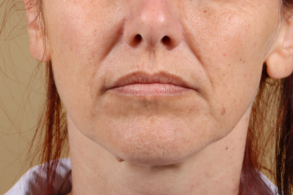 التجاعيد حول الفم تعطي انطباعاً بالتعب والتقدم في السن