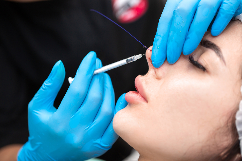 الخيوط التجميلية،   من التقنيات الحديثة لتحسين تفاصيل الأنف