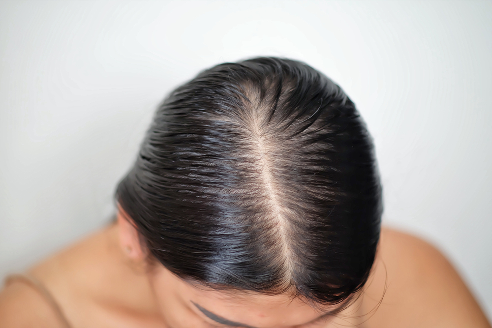 العلامات المبكرة لترقق الشعر اتساع الفرق