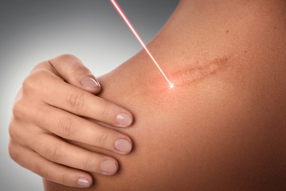 تعتمد عمليات التجميل بالليزر على استخدام أشعة ضوئية مركزة ذات أطوال موجية محددة