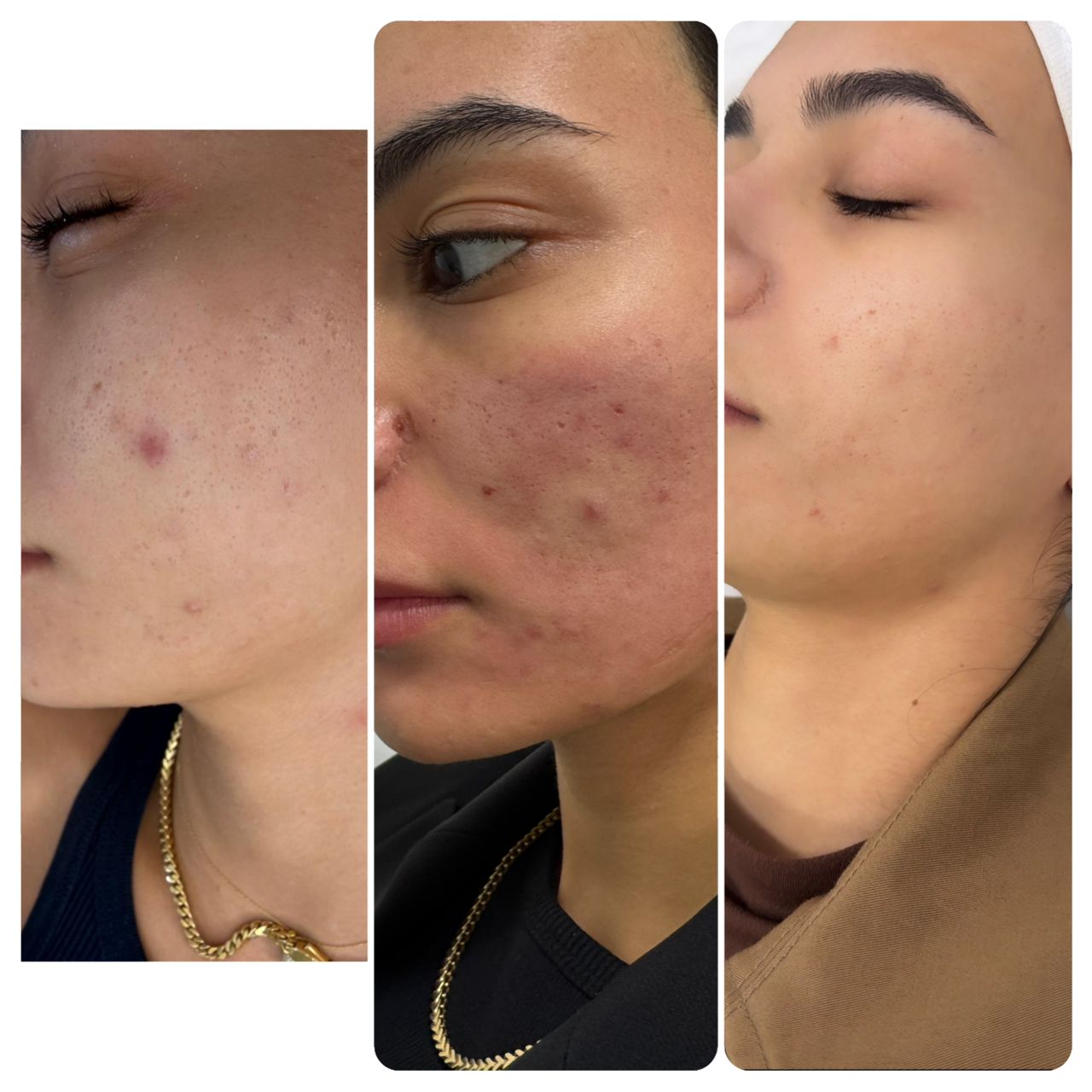 تقنيات تجميلية يجب تجنّبها للحفاظ على بشرة صحية