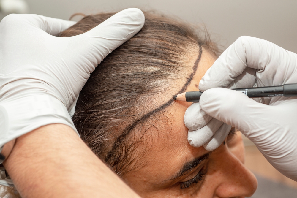 تقنية زراعة الشعر خياراً طبياً مناسباً لبعض النساء