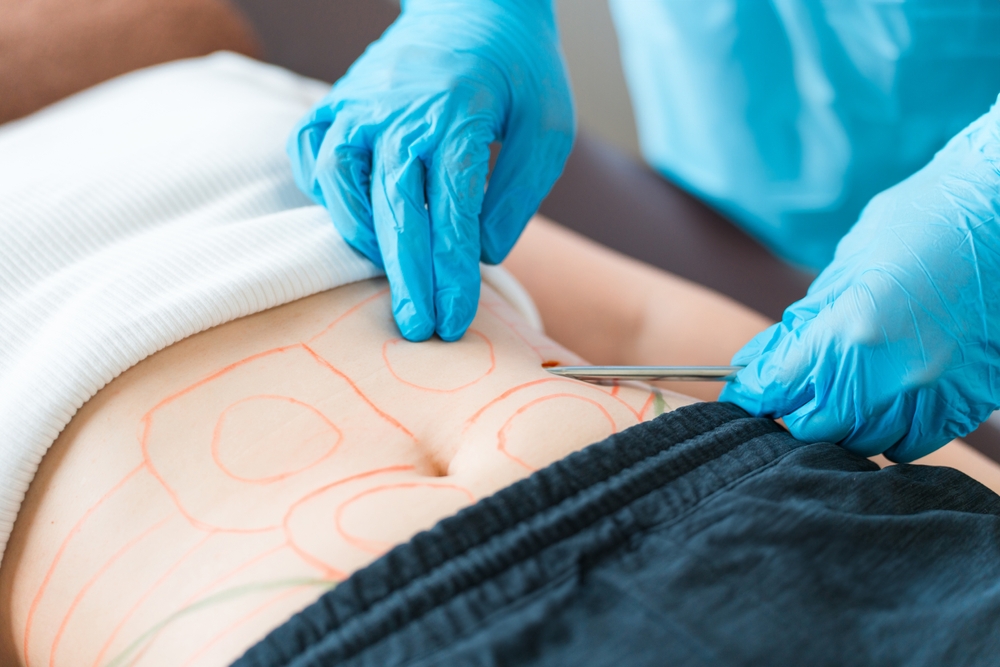 تقنية شفط الدهون (Liposuction) تُعد من الإجراءات الجراحية الفعّالة لنحت الخصر