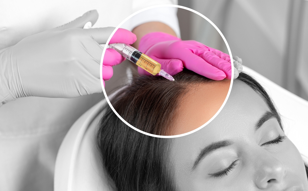 جلسات البلازما من أهم العلاجات الطبية حيث تُستخرج البلازما من دم المريضة نفسها ثم تُعاد إليها عبر فروة الرأس