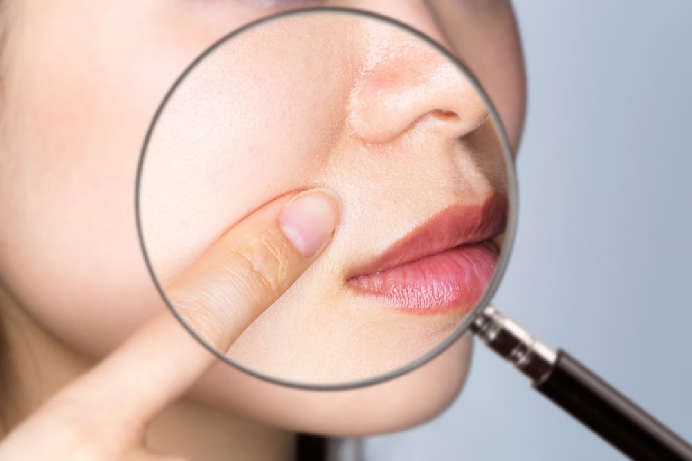 حمض الريتينويك يساعد في علاج التجاعيد العميقة