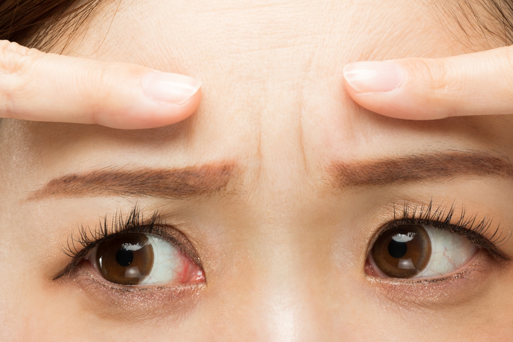 رفع الحواجب التقليدي مثالي للحالات المتقدمة من الترهل