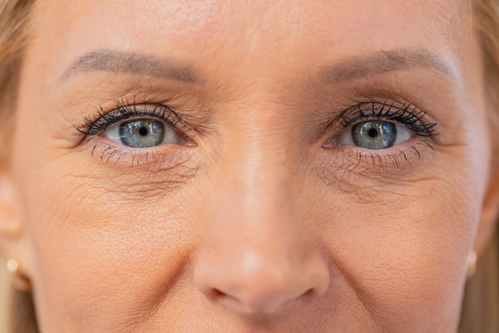 رقة الجلد حول العيون يسبب بظهور الخطوط بشكل مبكر