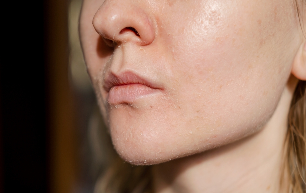 في الشتاء، يجب تقليل التقشير لأنه يزيد التهيّج والالتهابات