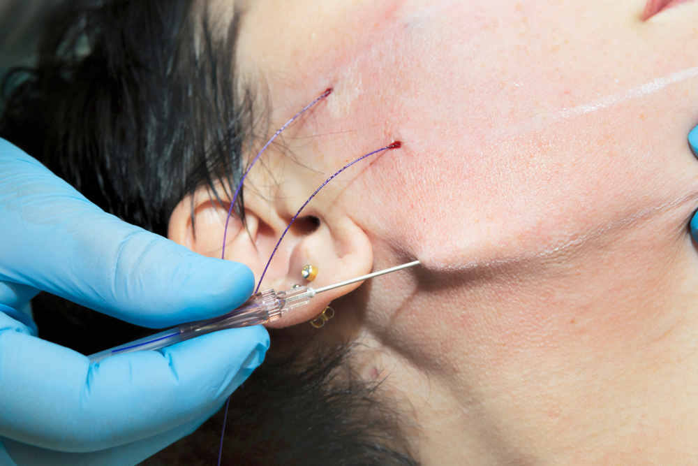 في حالات الاستعجال، لا تُعتبر الخيوط التجميلية  الخيار المثالي قبل مناسبة قريبة جدًا