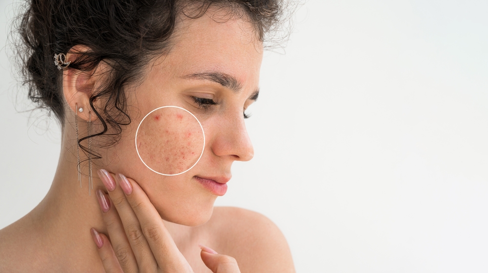 قلة النوم والتوتر المزمن يسببان بإلتهاب جلدي