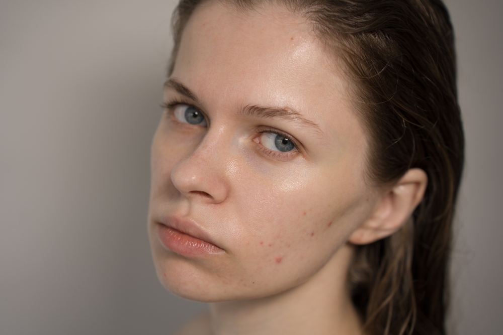 للبشرة الدهنية والمعرضة للحبوب تحتاج إلى عناية دقيقة توازن بين الترطيب والتحكم في الإفرازات