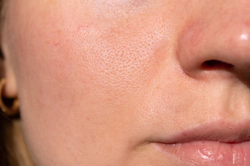 مميزات تقنية HydraFacial تقشير يقلل انسداد المسام