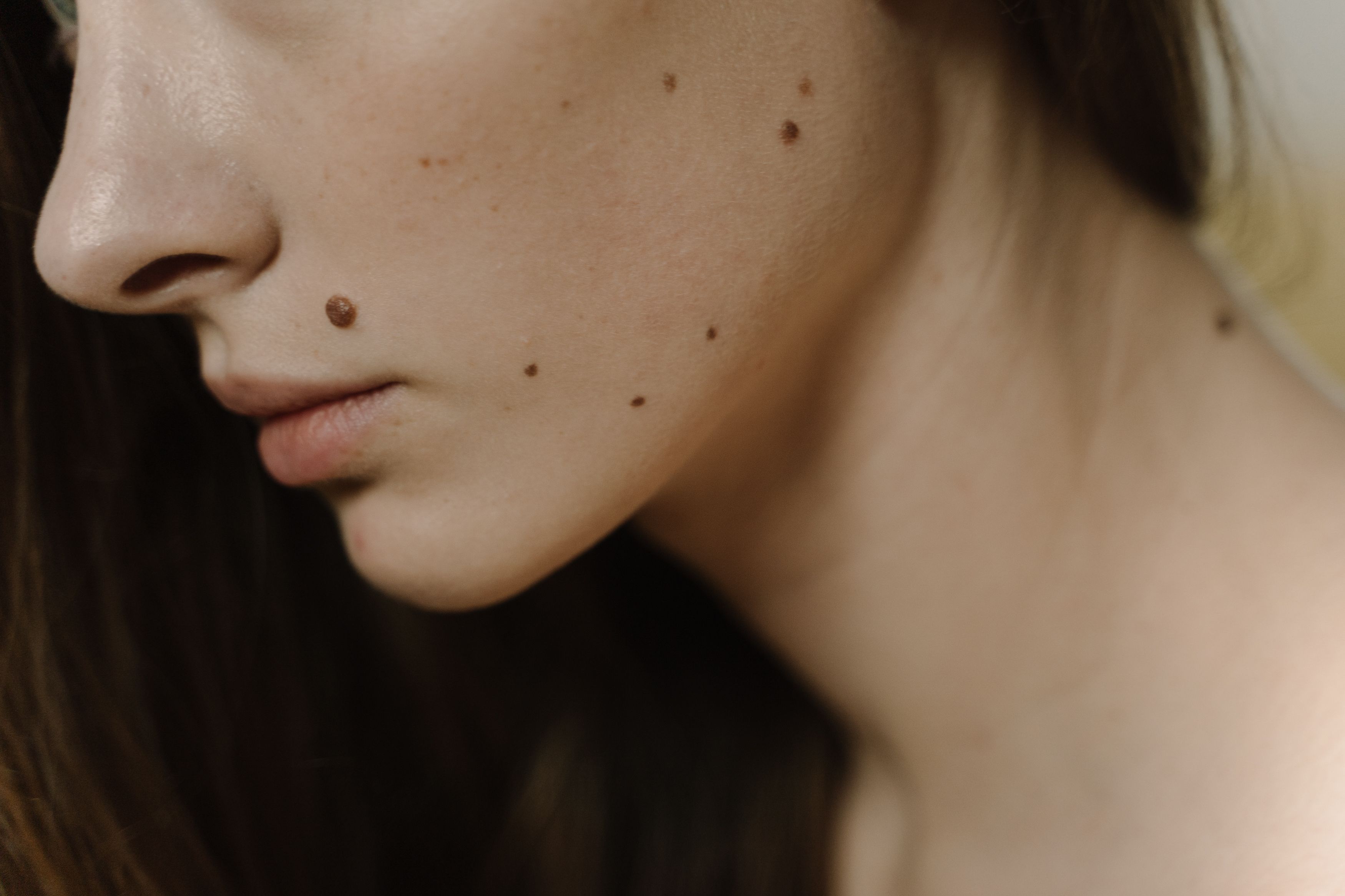 يساعد النيتروجين السائل على تجميد الثآليل وبعض الزوائد الجلدية
