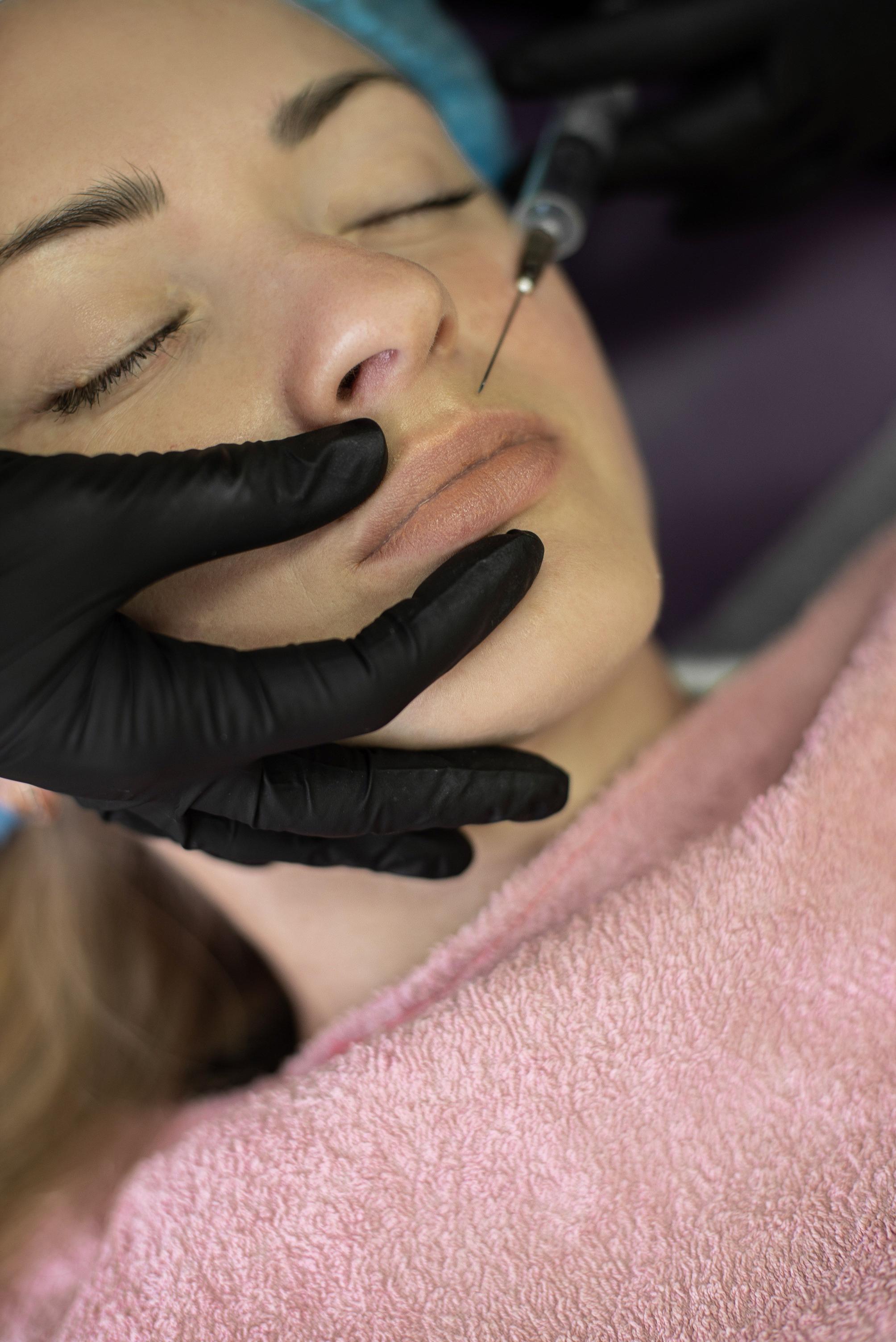 يعتمد Italian Lip Lift على شقوق أكثر تحديداً وصِغراً أسفل فتحتي الأنف