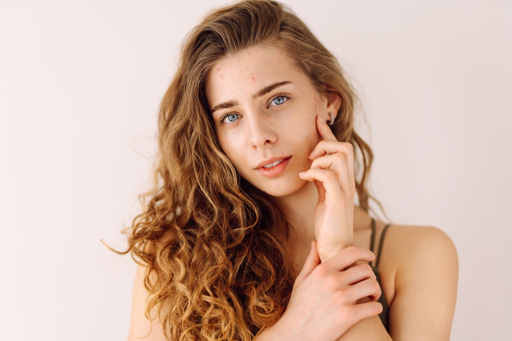 يقوم الزبادي بتهدئة حب الشباب   والالتهاب بدل قمعه