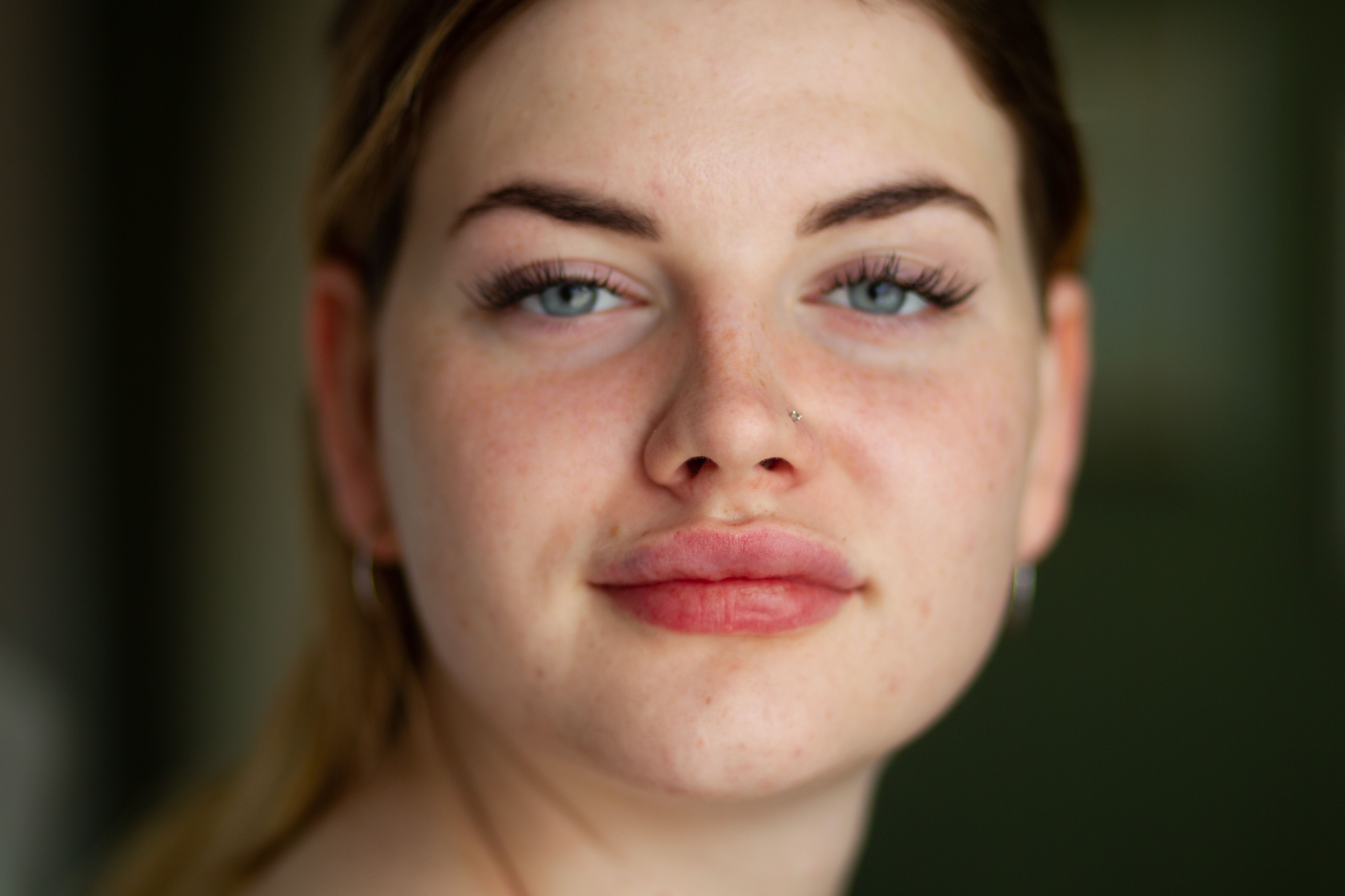 Lip Lift  فلا يعتمد على إضافة مادة إلى الشفاه، بل على رفع موضع الشفة العلوية