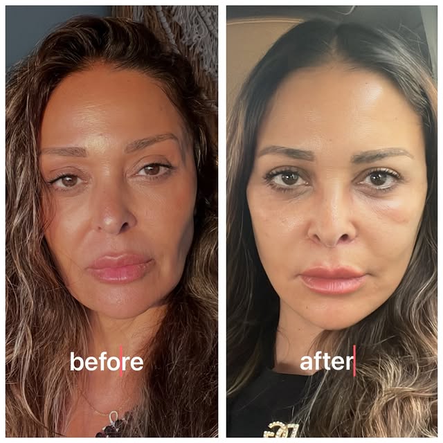 داليا البحيري اصغر سنا بـلـ Deep Plane Facelift