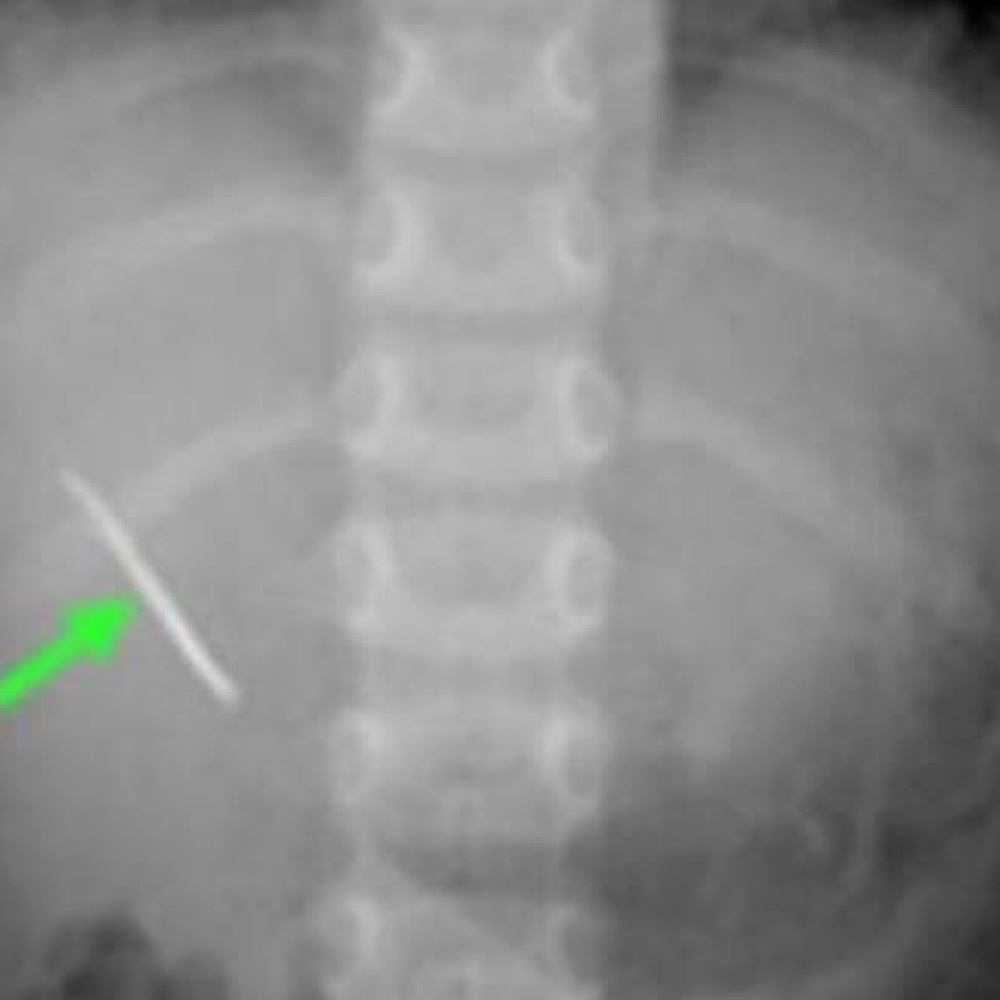 جراحة غريبة لطفل سعودي ابتلع دبوساً... فهل نجا؟