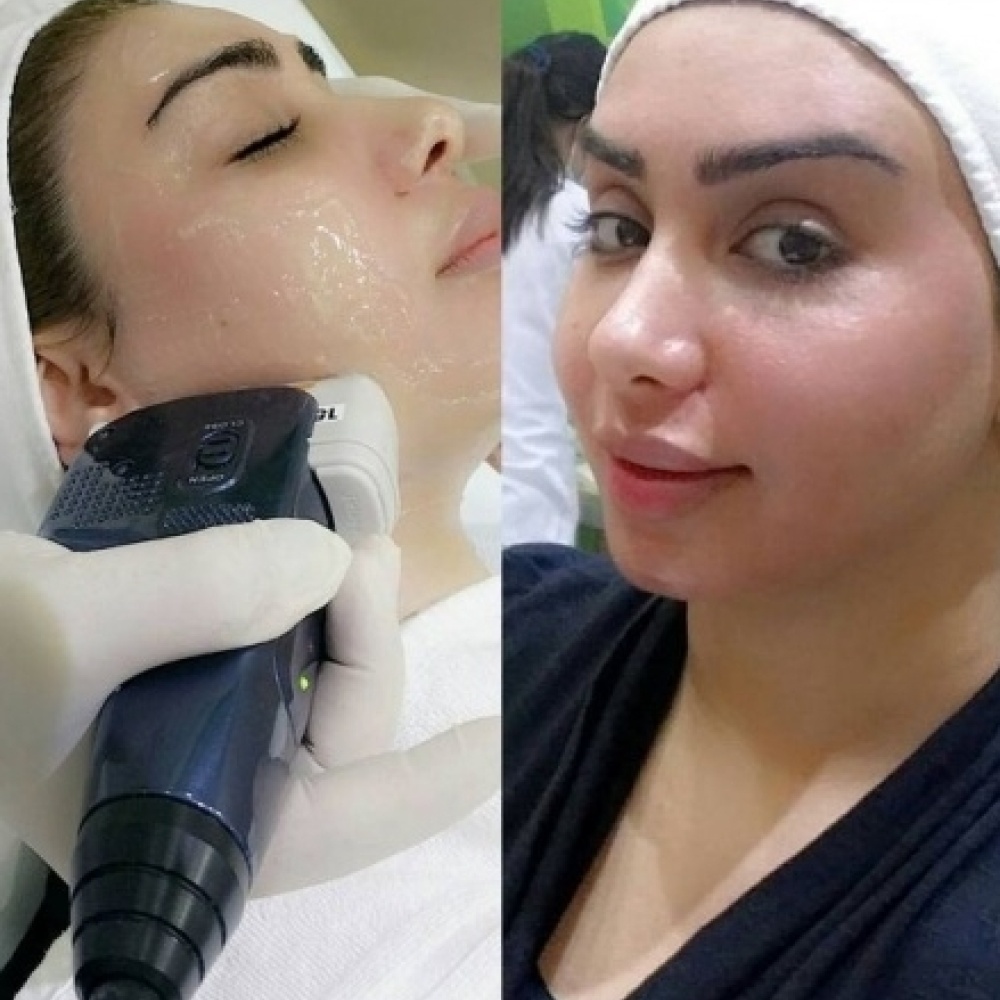 هنادي الكندري تخضع لجلسة شد الوجه