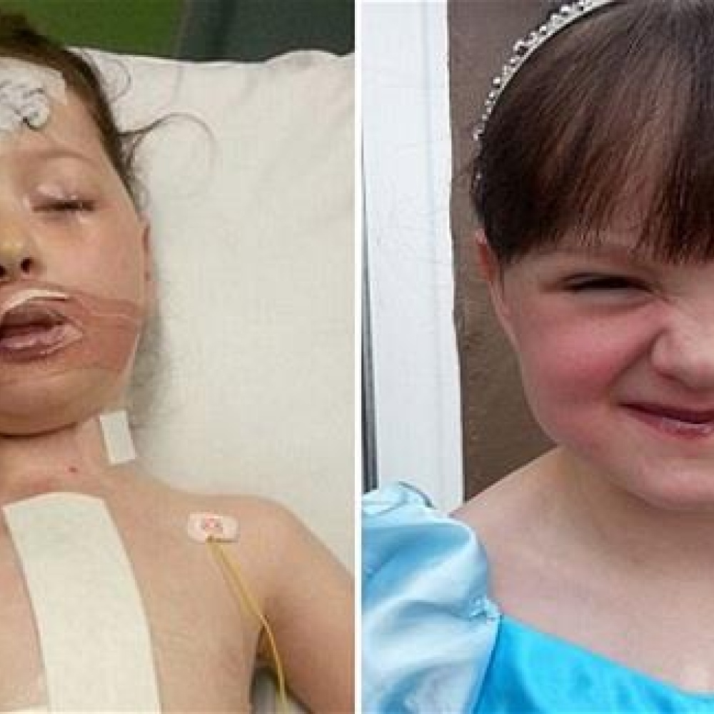 الفياغرا تنقذ طفلة مصابة في القلب والمعدة والأمعاء