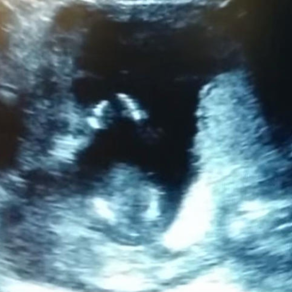 فيديو.. جنين يصفق في رحم أمه