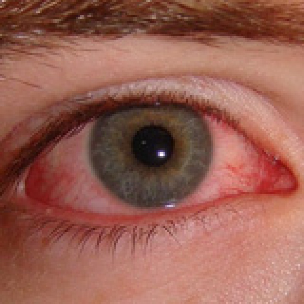 خطوات تجنب الاصابة بالرمد