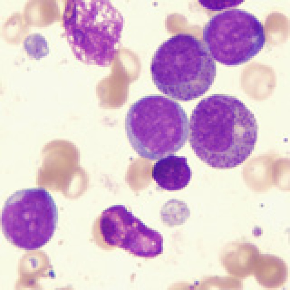 دفع خلايا سرطان الثدي لقتل نفسها