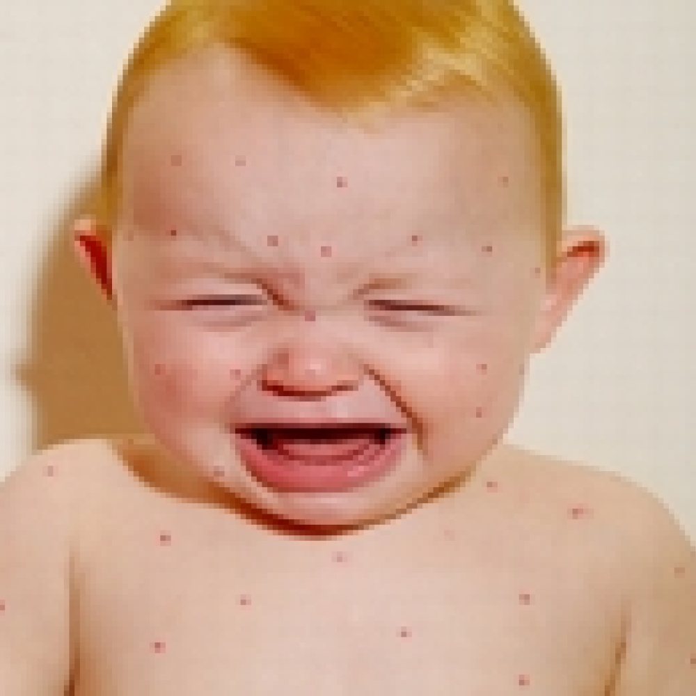 التعرض للشمس يقي من جدري الماء