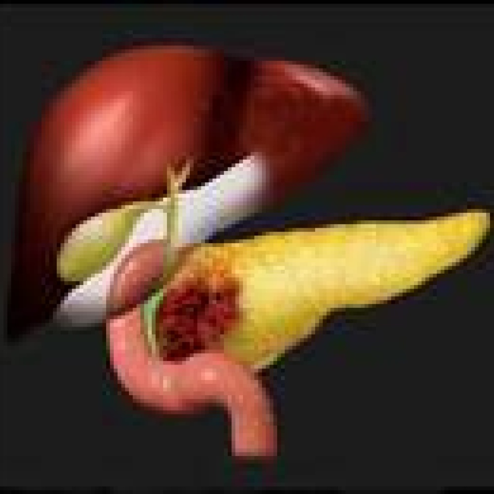 فيتامين A يحارب سرطان البنكرياس