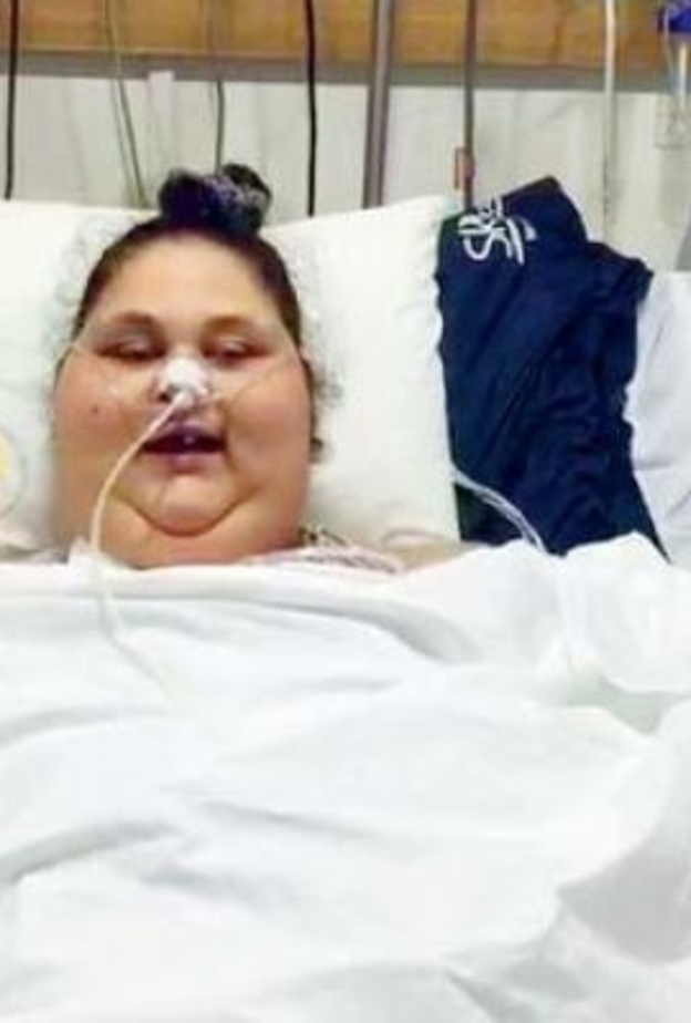 إصابة أسمن فتاة في العالم بالشلل واتهامات للطبيب الهندي بالتقصير