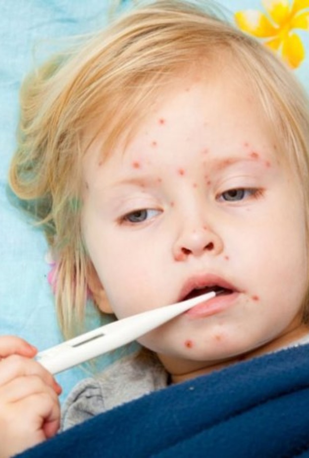 يجب ابعاد الطفل المصاب عن الآخرين لتجنب العدوى