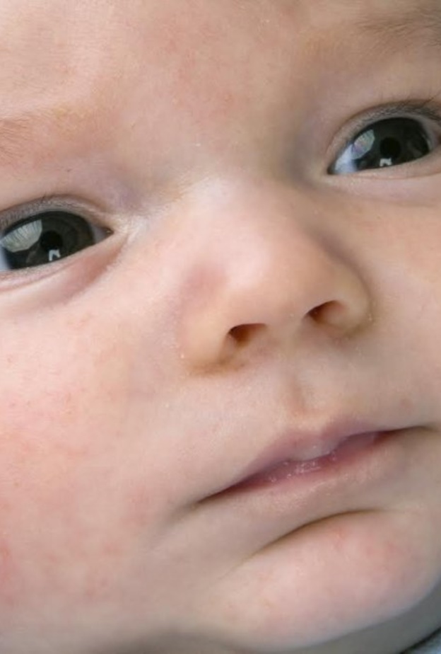 حمو النيل عند الرضع في فصل الصيف اسبابة وطرق علاجه