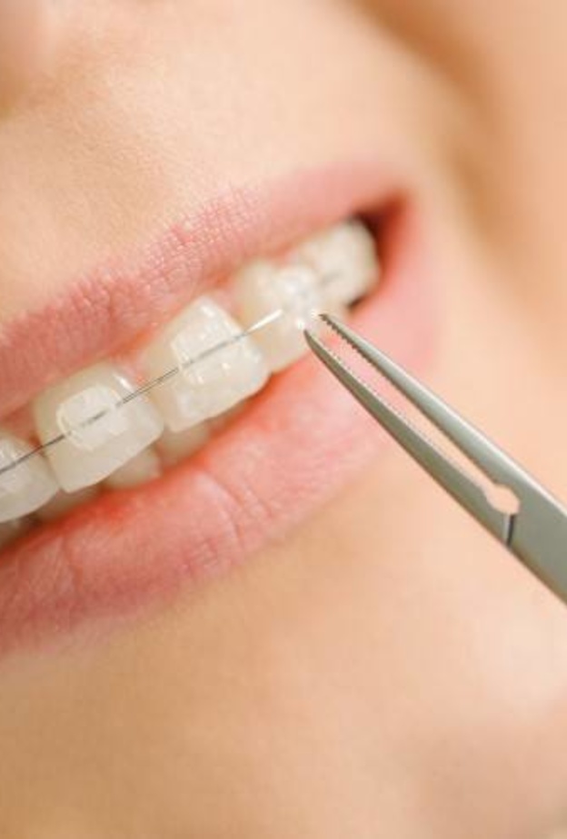 تقويم الأسنان له عدة أنواع حسب الحالة المرضية