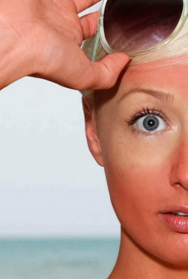 معالجة حروق الشمس بصودا الخبز