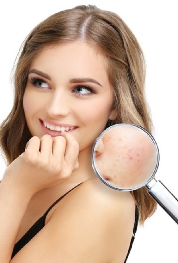 اعشاب طبيعية للتخلص من حب الشباب 