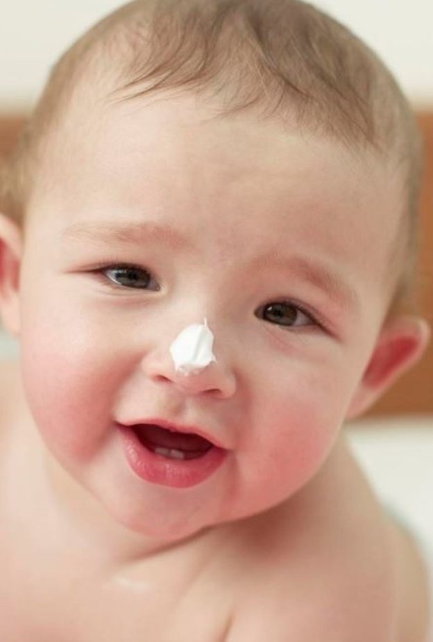 الاكزيما البنيوية