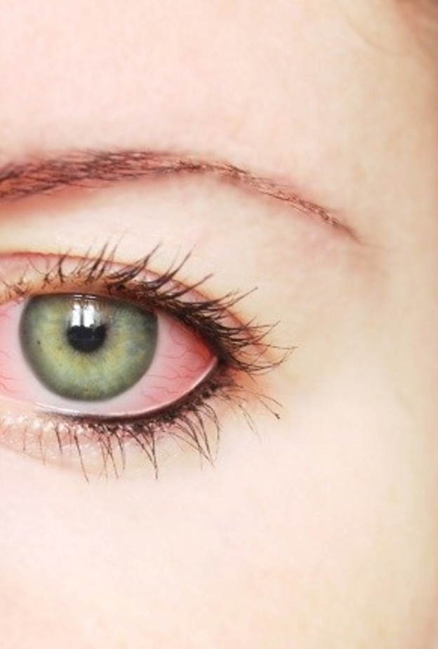 احمرار العينين