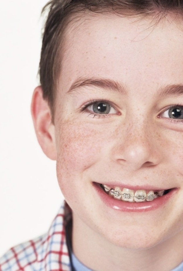 انواع تقويم الاسنان