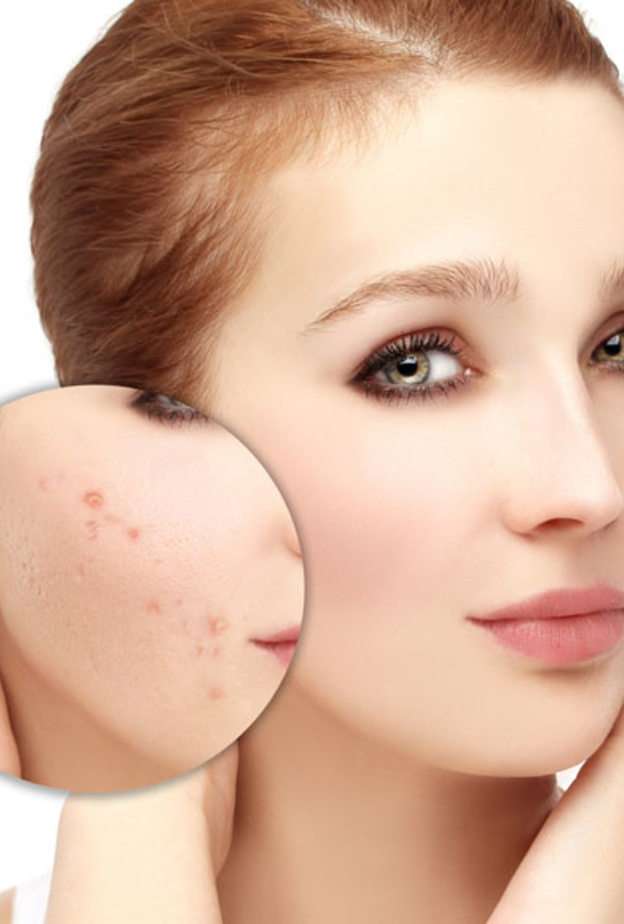 أهم الوصايا للتخفيف من حب الشباب