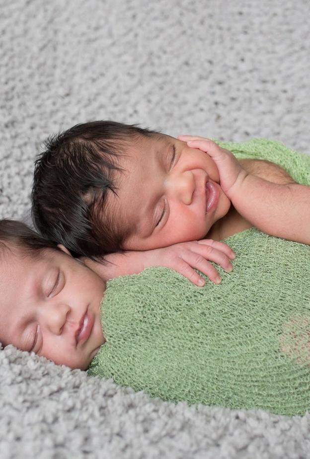 توأم سيامي بعد عملية فصلهما