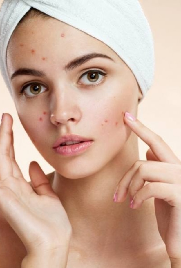 حب الشباب و حقيقة علاقته بالحليب 