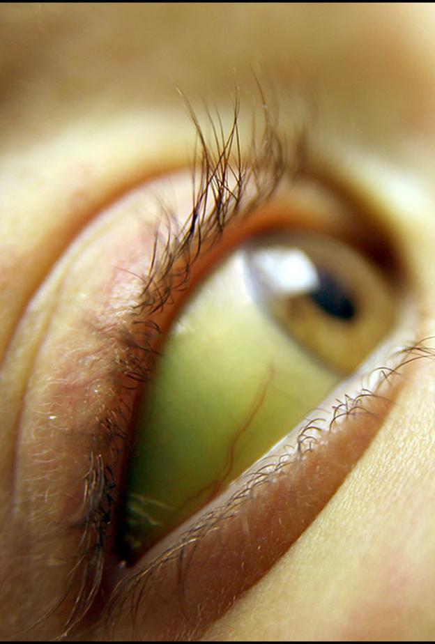  اليرقان أحد الأمراض التي تسبب إصفرار العين