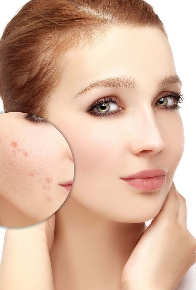 حب الشباب هو أكثر الامراض الجلدية شيوعا لدى الشباب