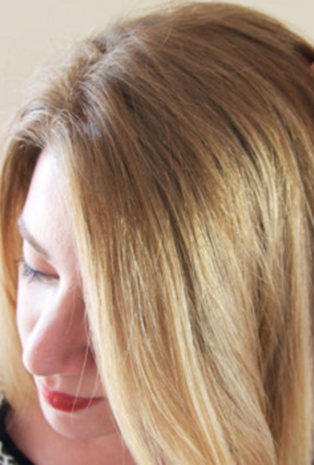 قشرة الشعر و الحكة من أعراض الإصابة بالصدفية