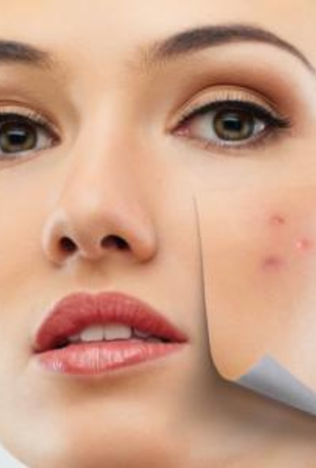 علاج حب الشباب للبشرة الدهنية 