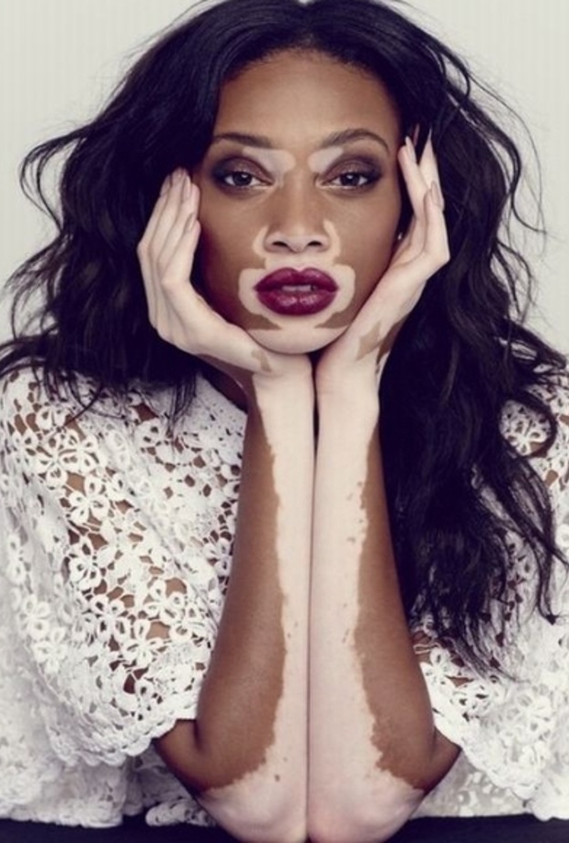 عارضة أزياء بمرض نادر تدخل قائمة النجمات الأكثر أناقة!