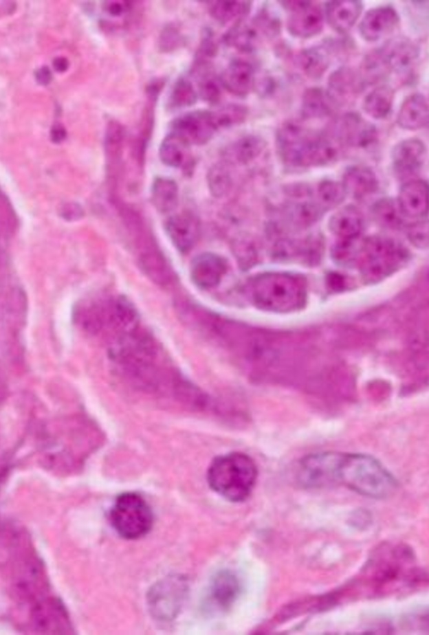 لسلامتكم .. إحذروا دودة السرطان!