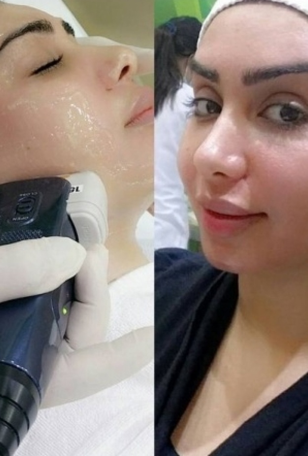 هنادي الكندري تخضع لجلسة شد الوجه